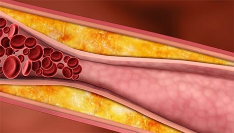  An example of arterial calcification and plaque buildup with restricted blood flow.  MK-7 supports cardiovascular and arterial health.